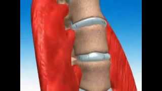 SPINAL DISC DECOMPRESSION THERAPY: TALLINN, ESTONIA, EU: Dr. Allan Austin Oolo.