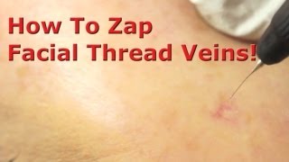 Remove Facial Thread Veins - a guide for doctors and nurses