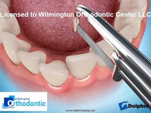Interproximal Reduction Crowding (Hand File)
