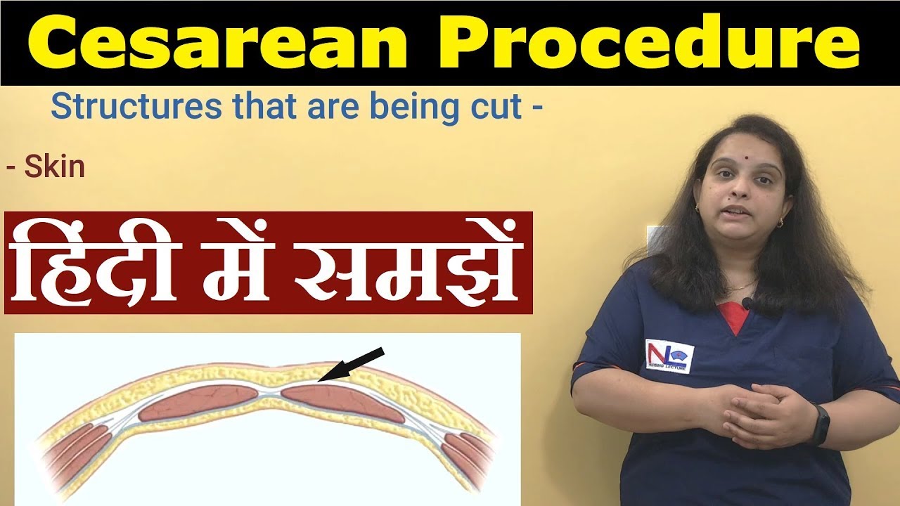 Cesarean Delivery in Hindi | Preoperative Care, Procedure, Postoperative care | Nursing Lecture