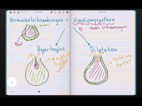 Behandlung der Hypertonie nach einem Schlaganfall Herz rechten Ventrikel Hypertonie