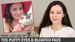 How I Fixed My Puffy Eyes, Swollen Face & Improved my Skin