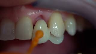 Συγκόλληση #γέφυρας Μέριλαντ -Closeup #bonding #Maryland bridge