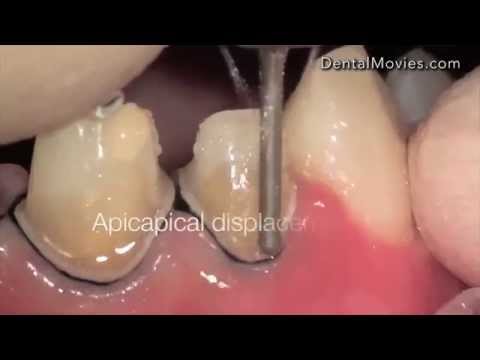 Tooth preparation under microscope - front four, esthetic case