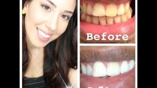 How to whiten EXTREMELY yellow teeth at home (with actual pictures)