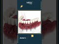 All On 6 Dental Implant Procedure In Turkey 2023