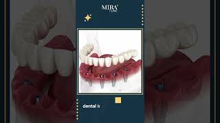 All on 6 dental implant procedure in turkey 2023