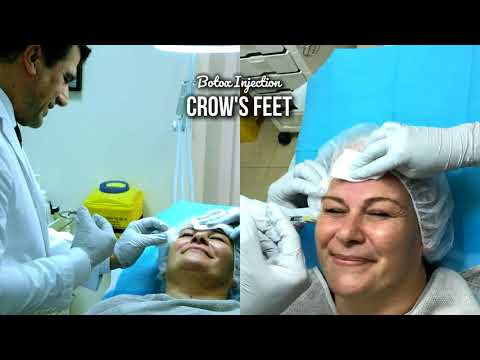 Botox Injection in Crow's Feet - with Dr Allen Rezai