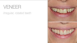 edelweiss Veneer - Treatment by Dr. Claudio Novelli in Milan