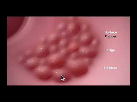 Colonoscopy: Assessment of a flat lesion - Graphic Illustration