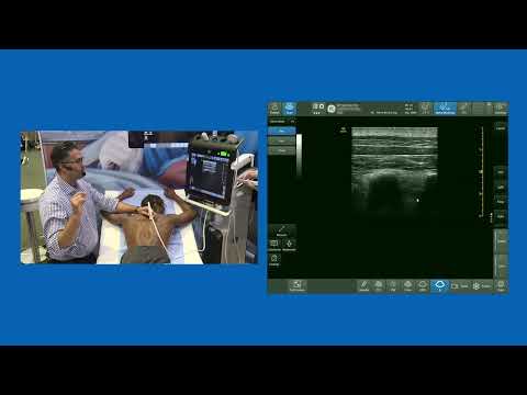 MTP (Mid-point  between Transverse process & Pleura) Block - aka:  InterTransverse Plane (ITP) Block