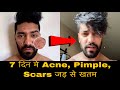 Remove Acne & Pimple Permanently In 7 Days | How To Get Clear, Glowing & Fair Skin Naturally