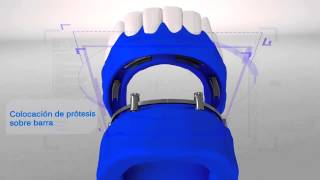 Sobre dentadura | www.dentydent.es