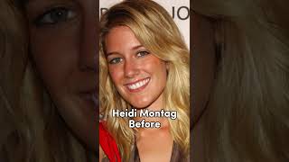 Heidi Montag Before And After Surgery || #celebrity #beforeandafter #model