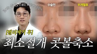 필러 제거 후 콧대/코끝 개선! 미니 콧볼축소로 완성한 자연스러운 코성형 11개월 경과 (실리콘 + 비중격 연골)