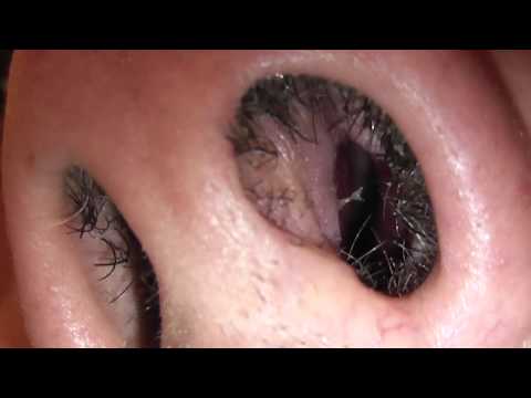 Papiloma genital femenino sintomas