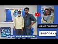 Episode 1 Live Hair Transplant Procedure FUE Tamil Hair Transplant Tamilan Ht