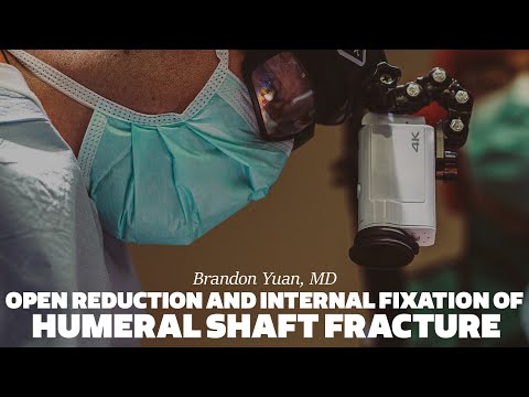 Open Reduction and Internal Fixation of Humeral Shaft Fracture by Brandon J. Yuan, MD