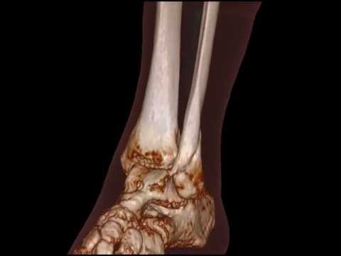Joint Connects Krankheit Ellenbogen Bursitis