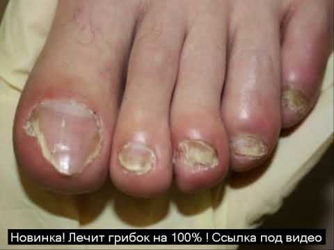 Kuko paggamot suka gliserol Pamahid laban sa fungi para sa mga buntis na kababaihan