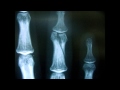 Blueneck - Broken Fingers 