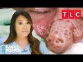 Bumpiest Nose Growths | Dr. Pimple Popper | TLC