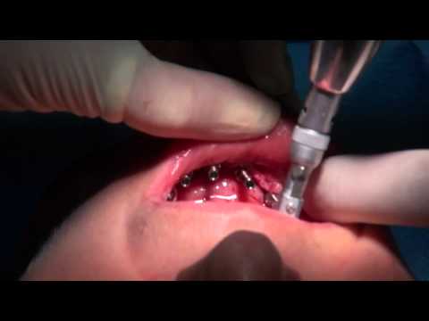 Full Arch Immediate Loading in mandible