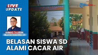 18 Siswa Terkena Cacar di SDN Blok I Cilegon Alami Cacar Air, 1 Kelas Dipulangkan agar Tak Tertular
