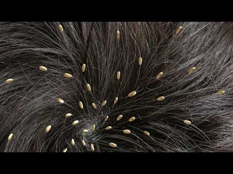 Info Kesehatan - Anda Kutuan ? Tenang ini Cara Menghilangkan Kutu Tak Bersisa