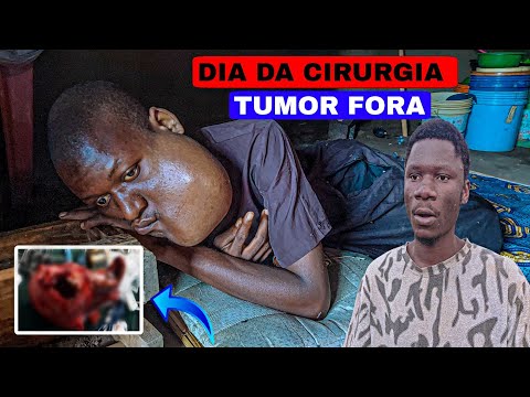 Doctors did something incredible with Elias Francisco's tumor in Mozambique, Africa.