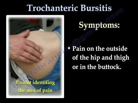 Csípő fájdalom - Csípő trocharteritis kezelésére szolgáló gyógyszerek