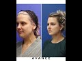 Reno Mini-Facelift, Neck Lift Before & After | Lake Tahoe Sharper Jawline | Avance Plastic Surgery