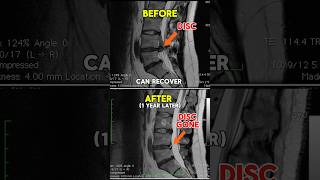 Download lagu Real Life Example: Low Back Disc Herniation Can Heal mp3 Download lagu Real Life Example: Low Back Disc Herniation Can Heal mp3