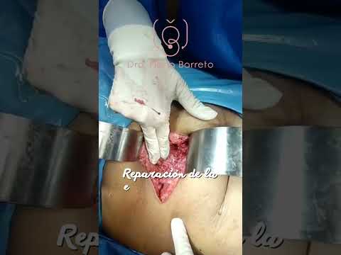 Eventración. Dra.MariaBarreto Guanare -Portuguesa