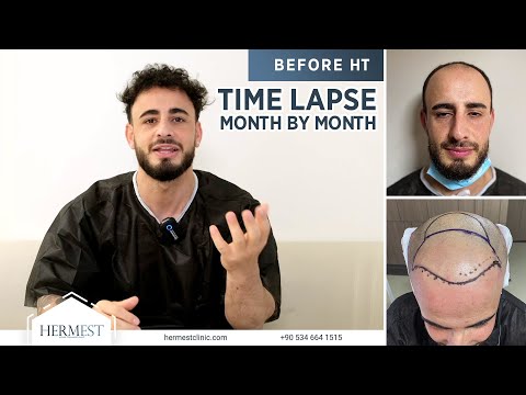 FUE Hair Transplant Time lapse Result in Turkey...