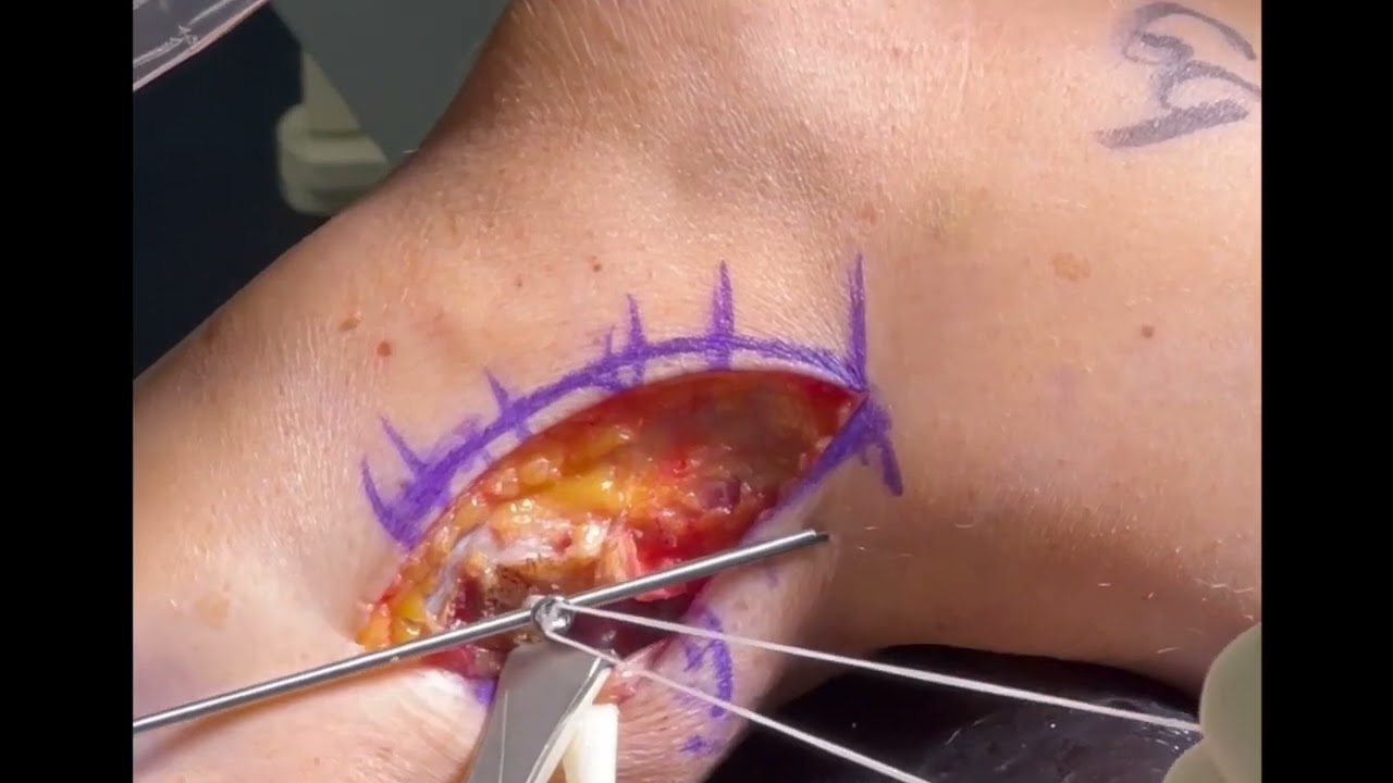 Proximal tib-fib stabilization using the cutting edge tightrope technique