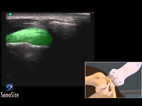 How To: Shoulder Ultrasound-Guided Injection of the AC Joint 3D Video