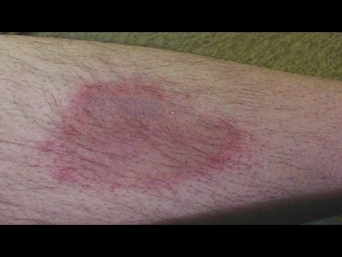 Ich habe ein Prostatavolumen von 23 Wie schnell hilft Prostamol