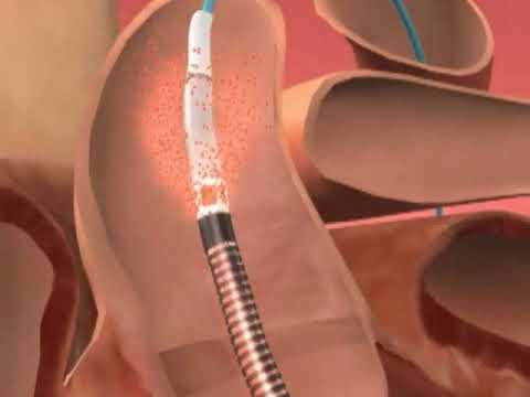 How Long Does Impella Surgery Take