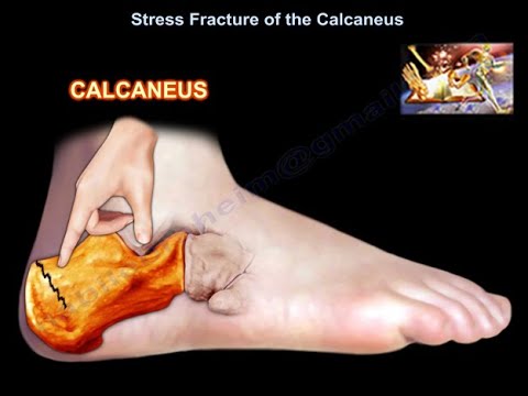 Stress Fracture of the Calcaneus 
