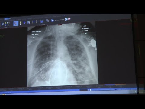 Ventura County doctors provide x-rays showing impacts of virus