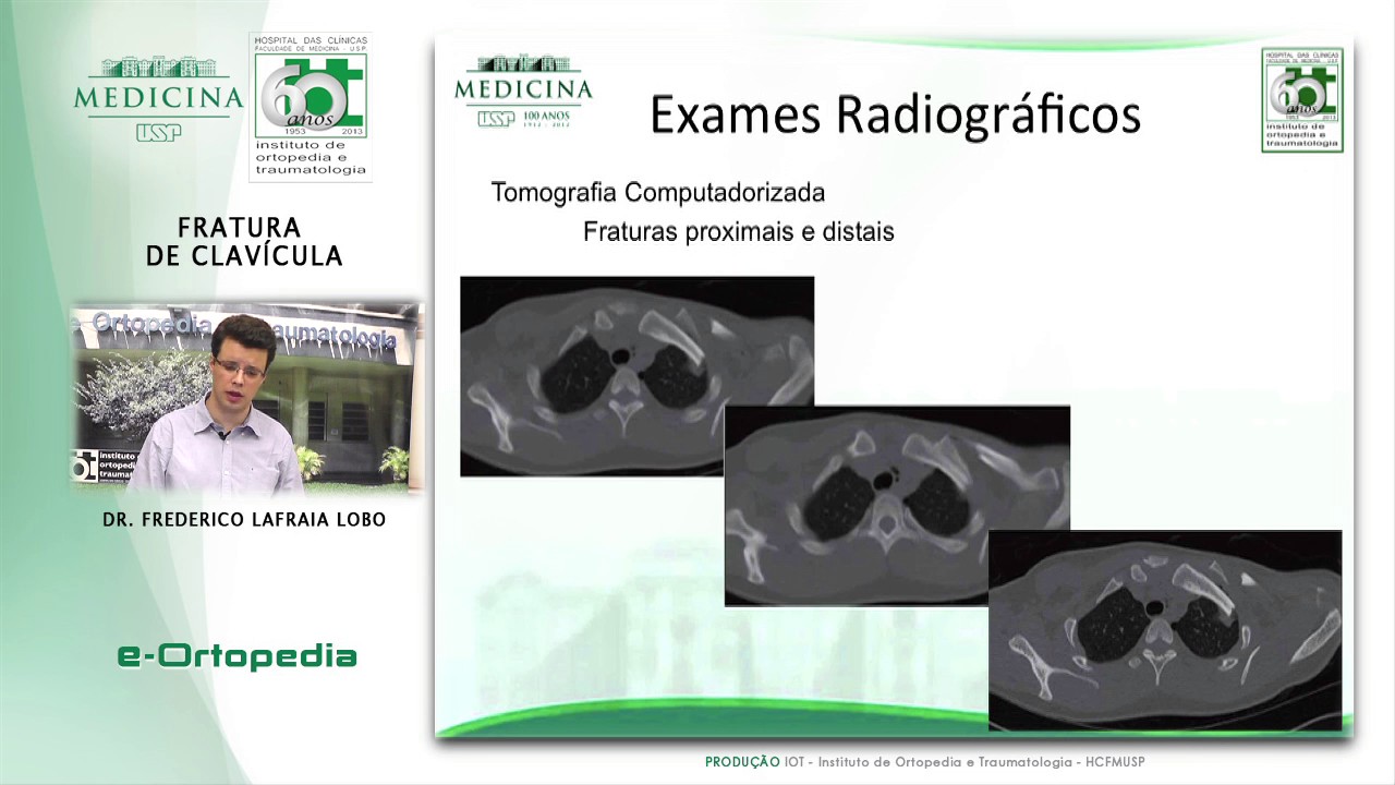 Fratura de Clavícula - Dr. Frederico Lafraia Lobo