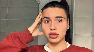 ASÍ ME QUEDA LA CARA TRAS 8 VIALES DE ÁCIDO