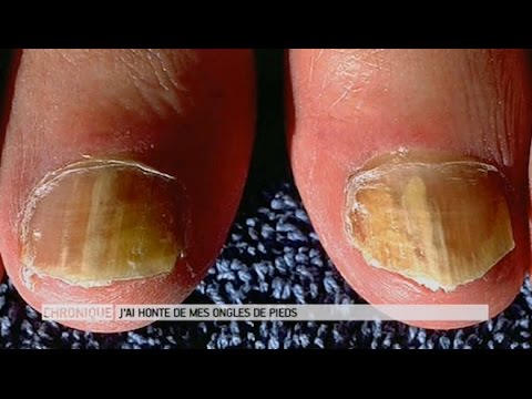 J'ai honte de mes ongles de pieds, que faire - Le Magazine de la santé