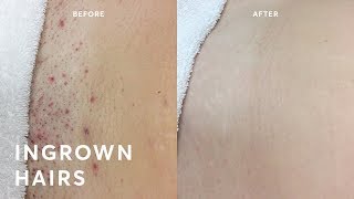 How to get rid of ingrown hairs? FOREVER!!!