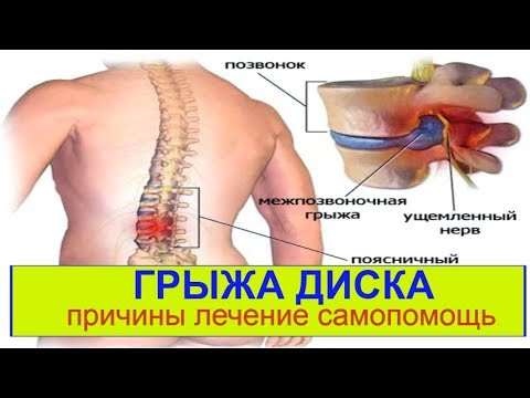 Боль слева сбоку сзади от поясницы Архангельск лечение спины