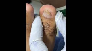 Ep_8797 Foot nails skin removal 👣 หนังก้อนในซอกนิ้ว..สังเกตุอย่างไรครับ 😅 (clip from Thailand)