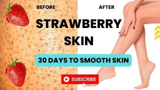 Strawberry Legs Home Remedies I Strawberry Legs Home Remedies Keratosis Pilaris Treatment & Removal