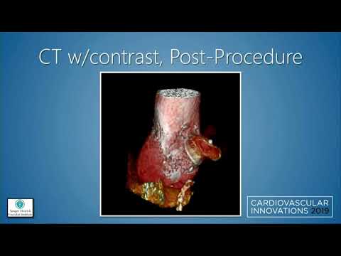 CVI 2019_Friday 7/19_ The Boundaries of Structural Heart Therapy II _Jonathan Schwartz, MD