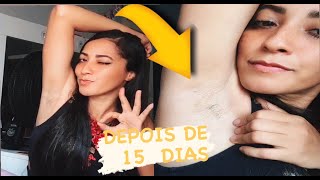1° SEÇÃO DE DEPILAÇÃO A LASER. OS PELOS CAÍRAM MESMO DEPOIS DE 15 dias🤔